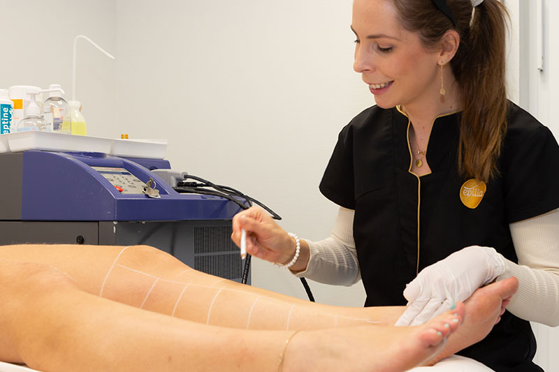 laser hair removal for legs 5