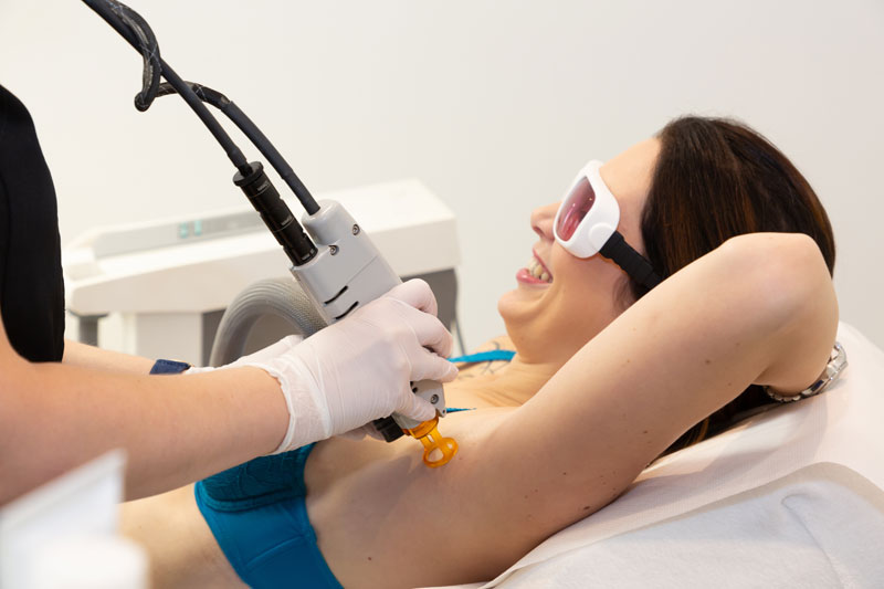 laser hair removal for underarms 3